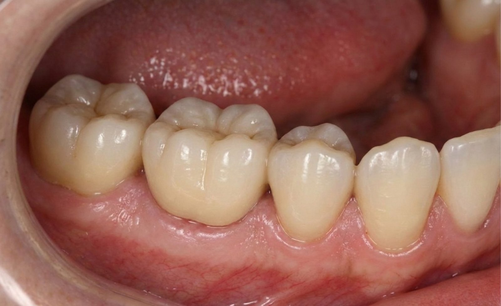 Bridge or Fixed Partial Denture